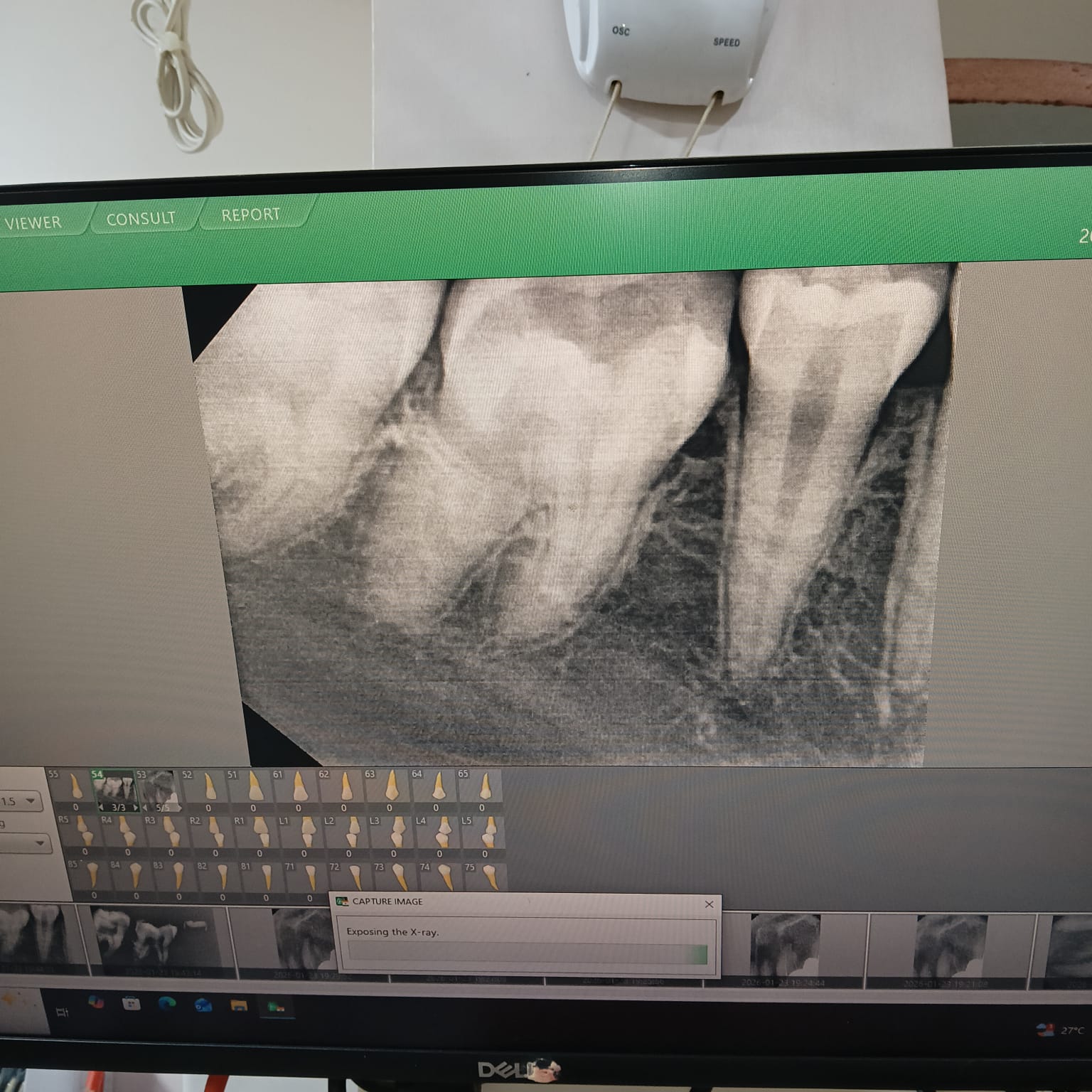 A periapical radiograph taken with the KARVI holder, displayed in dental imaging software.